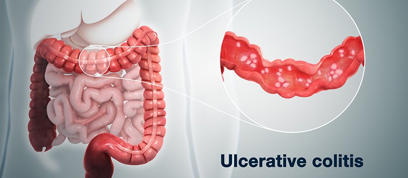 Ulcerative Colitis Image