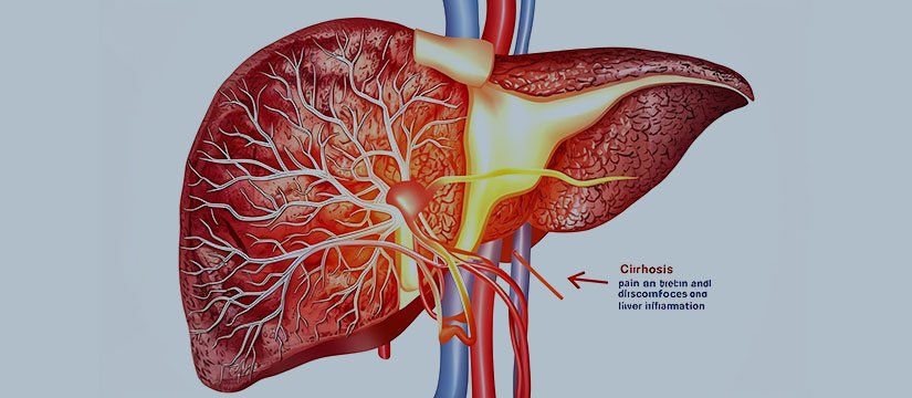 Cirrhosis Disease