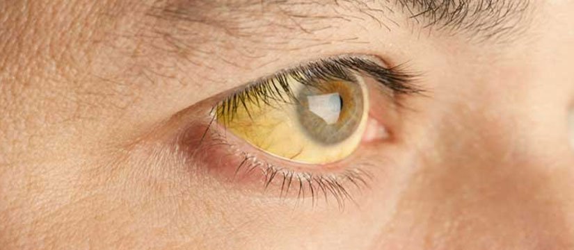 Obstructive Jaundice