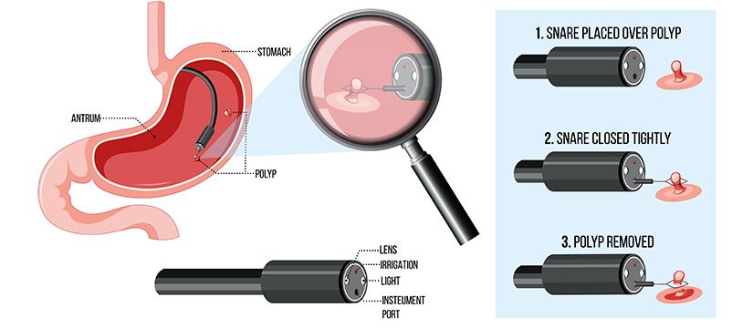 Upper GI Endoscopy Image