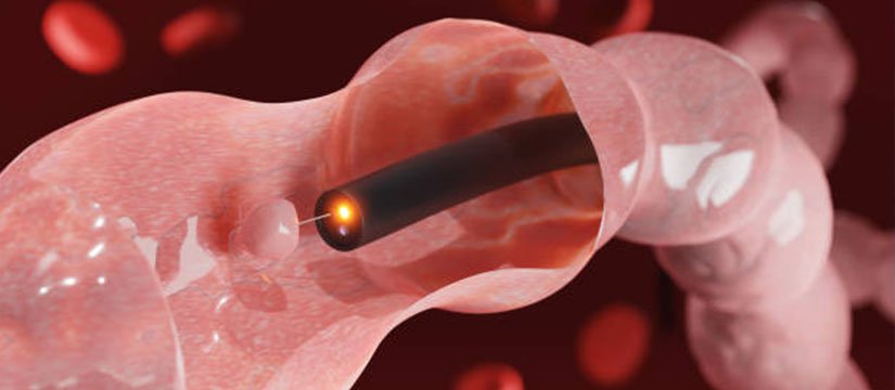 Endoscopic Biopsy Image