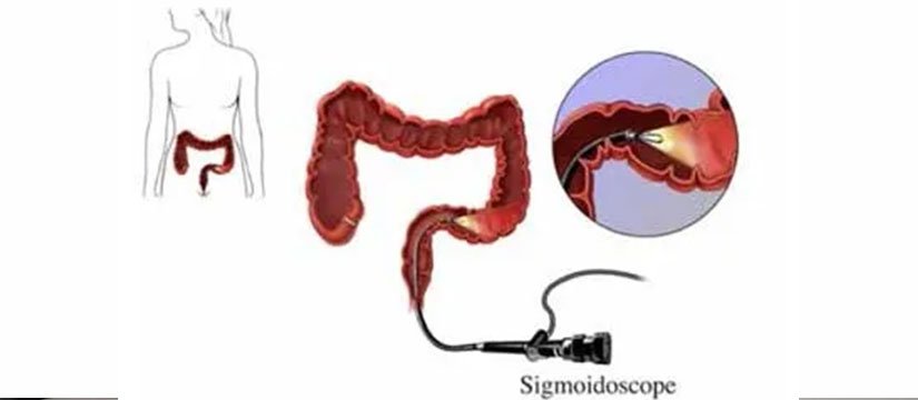 Flexible Sigmoidoscopy