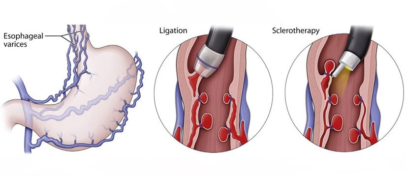 Endoscopic Variceal Band Ligation