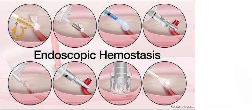Endoscopic Hemostasis