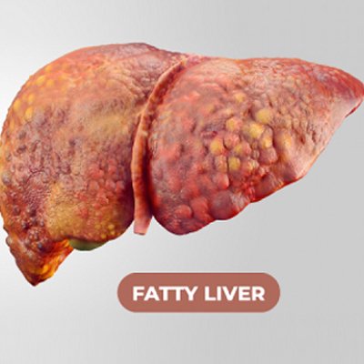 Fatty Liver