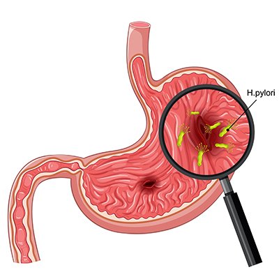 Peptic Ulcer Disease