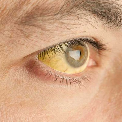 Obstructive Jaundice