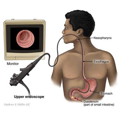 Upper GI Endoscopy