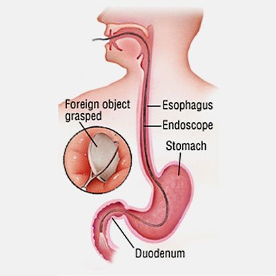 Foreign Body Removal