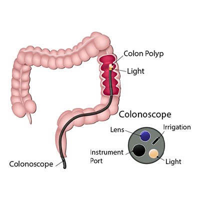 Flexible Sigmoidoscopy