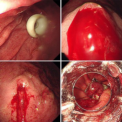 Endoscopic Hemostasis