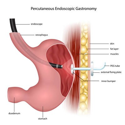 Percutaneous Endoscopic Gastrostomy
