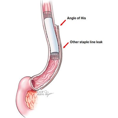 Endoscopic Stent Placement