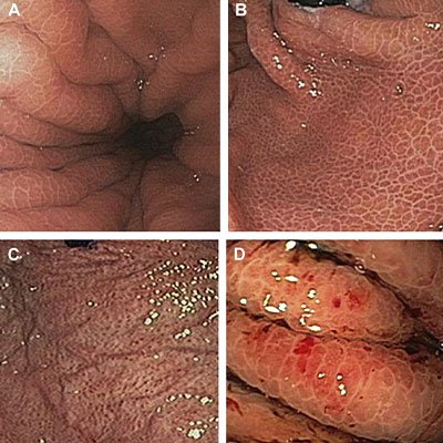 Therapeutic Endoscopy for Portal Hypertension