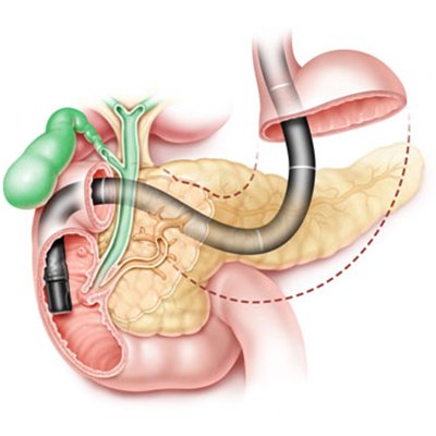 ERCP Procedure